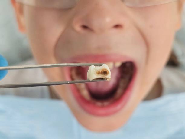 Best Broken Tooth Emergency  in Elma, WA